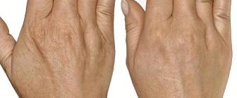 Руки до и после озонотерапии - коже стала гладкой
